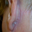 this is the scarring behind both of my ears...It is VERY OBVIOUS that I have had surgery from these scars and the ones on front. I cannot ever wear my hair up again like I used to on a daily basis. I wish to GOD I had listened to my husband and not had th